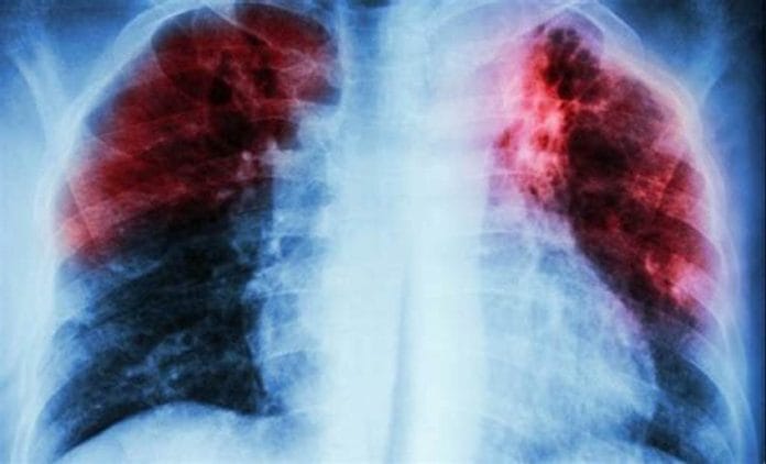 MSP busca reducir muertes por tuberculosis a través de Programa de control y prevención