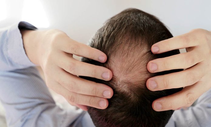 Expertos propusieron un método que podría revertir una forma de pérdida del cabello