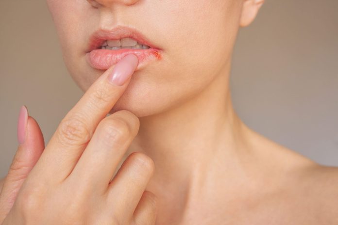 Estas son las causas por lo que se genera el herpes labial