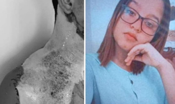 Emiten orden de arresto contra mujer que quemó a su cuñado con aceite caliente