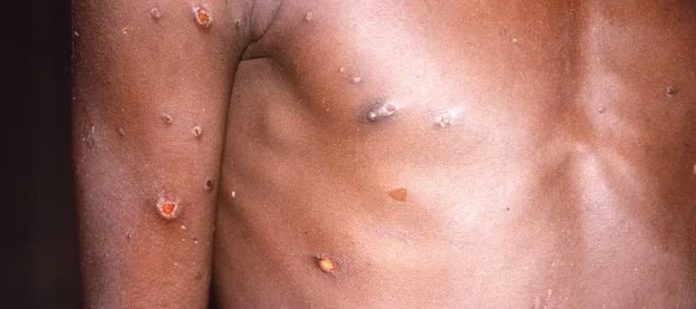OMS declara emergencia médica mundial por brote de viruela del mono en África
