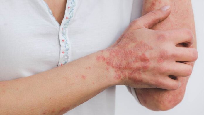 Morgellons: una enfermedad poco comprendida que afecta la salud física y mental