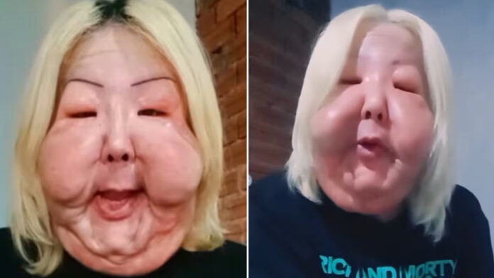 Durante esta primera intervención, los especialistas buscaron recuperar simetría en las mejillas y reducir la papada inflamada, que incluso dificultaba la correcta apertura bucal de la influencer.