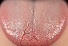 Sequedad bucal: por qué aumenta con la edad y cuáles son las estrategias para prevenirla