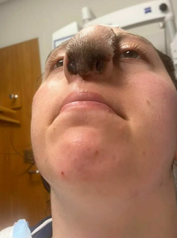 Mujer le crece pelo en la nariz tras ser atacada por un pitbull