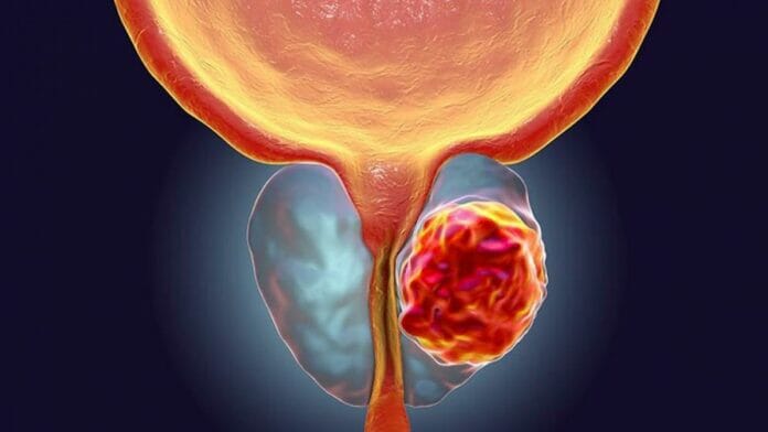 ¿Qué es el cáncer de próstata? la enfermedad que padece Danilo Medina