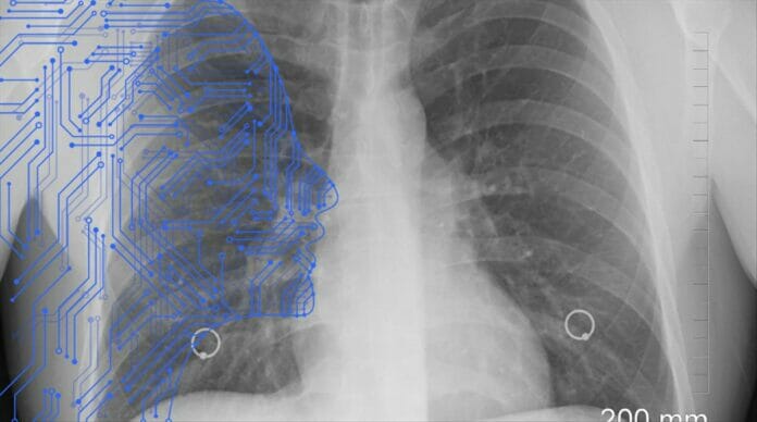 Inteligencia Artificial detecta signos tempranos de cáncer de pulmón antes que tomografía