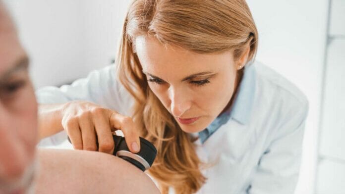 Melanoma: Algunas señales del cáncer de piel más agresivo