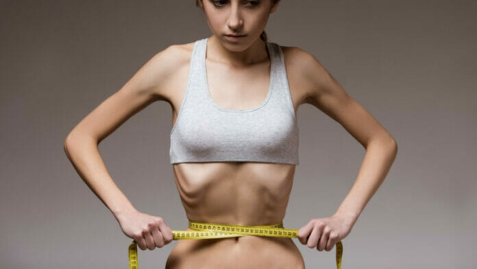 ¿Conoces la Anorexia Nerviosa?
