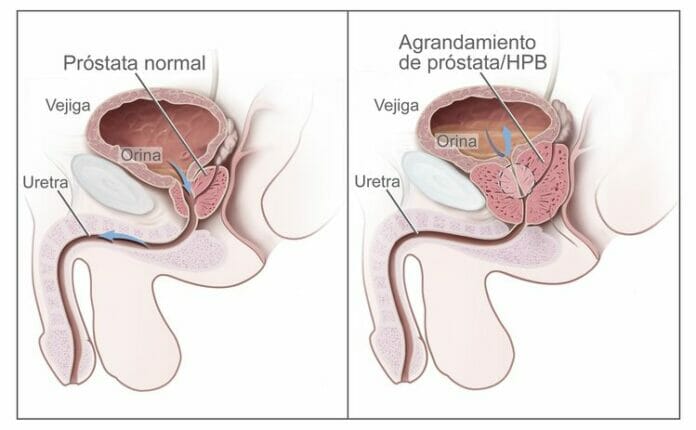 Afecciones precancerosas de la próstata