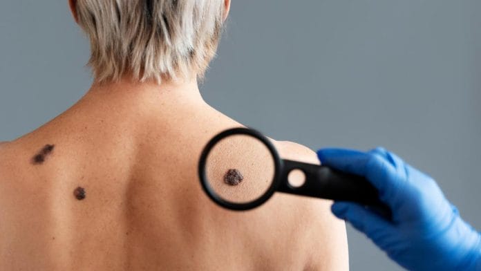 Después de los 40 años crecen más posibilidades de sufrir cáncer de piel