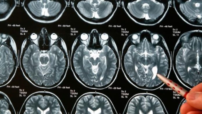 Día Internacional de los Tumores Cerebrales este sábado 8 de junio
