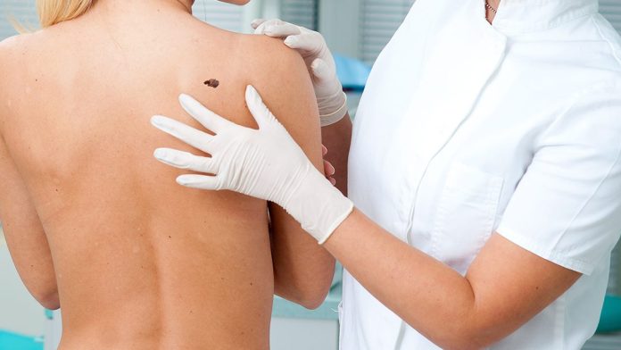 Día Mundial del Cáncer de Piel: signos de alerta de una patología que afecta a más de 1.2 millones de personas en el mundo