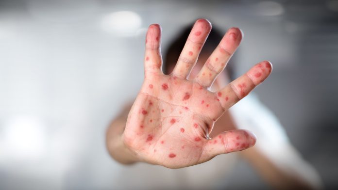 Salud Pública emite alerta epidemiológica por brote de viruela del mono