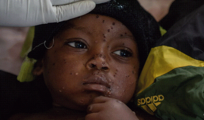 Casos de mpox en el Congo o viruela del mono se estabilizan, según la OMS