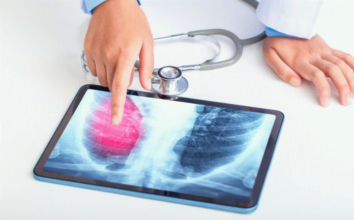 Crearon un dispositivo experimental que busca indicios del cáncer de pulmón en el aliento