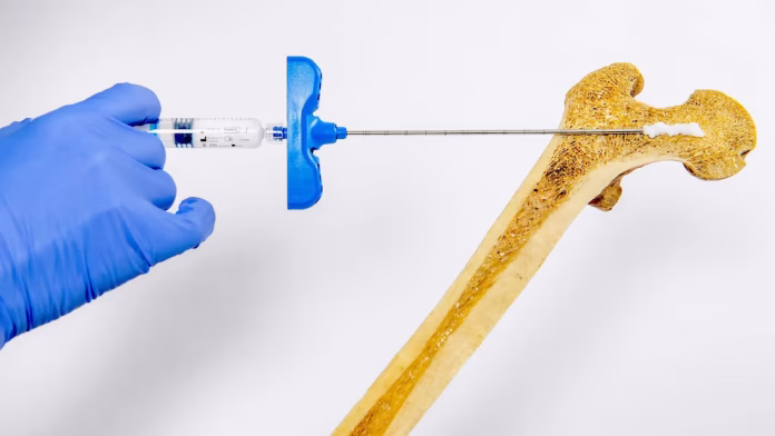 Nueva inyección de hidrogel podría reforzar huesos frágiles en semanas si padece osteoporosis
