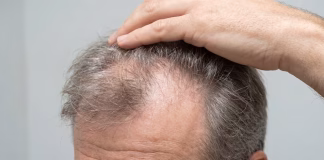 10 causas de la caída del cabello que pueden revelar un problema de salud